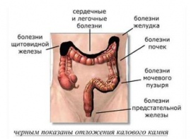 Лечение камней желчного пузыря в домашних условиях Лечение камней желчного пузыря в домашних условиях