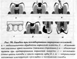 Пломбирование кариозных полостей v класса. Ошибки и осложнения при пломбировании кариозных полостей. Завышение прикуса при пломбировании кариозной полости.